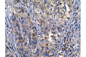 ABIN6262625 and ABIN6268687 at 1/100 staining Human ovarian cancer by IHC-P. (IL2 Receptor beta 抗体  (N-Term))