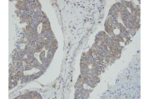 IHC-P Image Immunohistochemical analysis of paraffin-embedded human endo mitral ovarian cancer, using NMI, antibody at 1:100 dilution. (NMI 抗体)