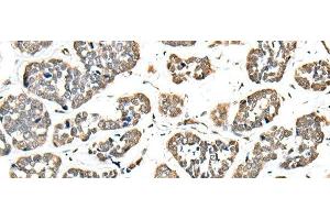 Immunohistochemistry of paraffin-embedded Human esophagus cancer tissue using EEF1E1 Polyclonal Antibody at dilution of 1:35(x200) (EEF1E1 抗体)