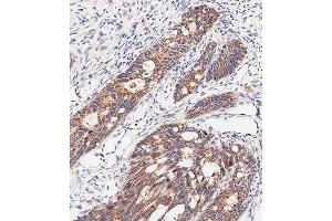 Immunohistochemical analysis of paraffin-embedded human colon carcinoma tissue using (ABIN651547 and ABIN2840295) performed on the Leica® BOND RXm. (SLC47A1 抗体  (C-Term))