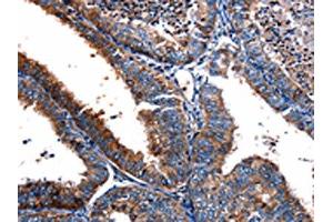 The image on the left is immunohistochemistry of paraffin-embedded Human cervical cancer tissue using ABIN7190708(FPR2 Antibody) at dilution 1/17, on the right is treated with synthetic peptide. (FPR2 抗体)