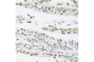 Immunohistochemistry of paraffin-embedded human colon carcinoma using SNAI1 antibody. (SNAIL 抗体)