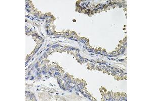 Immunohistochemistry of paraffin-embedded human prostate using ACO1 antibody (ABIN5995389) at dilution of 1/100 (40x lens). (Aconitase 1 抗体)