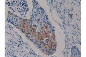 Immunohistochemistry (IHC) image for anti-S100 Calcium Binding Protein P (S100P) (AA 1-95) antibody (ABIN7434620)
