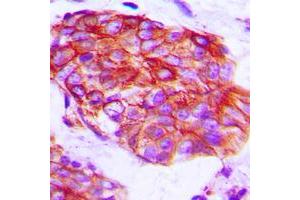 Immunohistochemical analysis of Claudin 6 staining in human prostate cancer formalin fixed paraffin embedded tissue section. (Claudin 6 抗体  (Center))