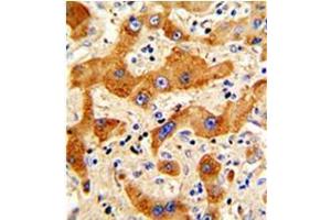 Formalin-fixed and paraffin-embedded human hepatocarcinoma reacted with Glucagon Antibody (N-term), Cat. (Glucagon 抗体  (N-Term))