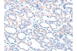 The image on the left is immunohistochemistry of paraffin-embedded Human thyroid cancer tissue using ABIN7128186(ACSM5 Antibody) at dilution 1/35, on the right is treated with fusion protein. (ACSM5 抗体)