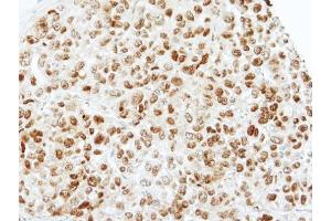 IHC-P Image Immunohistochemical analysis of paraffin-embedded CL1-0 xenograft, using TAFII68, antibody at 1:100 dilution.