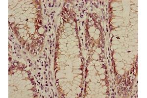 Immunohistochemistry of paraffin-embedded human colon cancer using ABIN7146984 at dilution of 1:100 (CTNNB1 抗体  (AA 2-781))