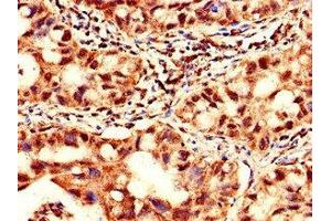 Immunohistochemistry of paraffin-embedded human lung cancer using ABIN7175942 at dilution of 1:100 (YTHDF2 抗体  (AA 201-500))