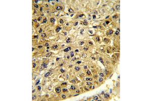 Formalin-fixed and paraffin-embedded human hepatocarcinoma reacted with DCT Antibody (N-term), which was peroxidase-conjugated to the secondary antibody, followed by DAB staining. (DCT 抗体  (N-Term))