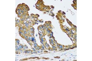 Immunohistochemistry of paraffin-embedded human colon carcinoma using SLC25A13 antibody (ABIN6292454) at dilution of 1:100 (40x lens). (slc25a13 抗体)