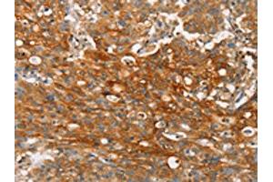 The image on the left is immunohistochemistry of paraffin-embedded Human gastic cancer tissue using ABIN7190272(CLDN11 Antibody) at dilution 1/25, on the right is treated with synthetic peptide. (Claudin 11 抗体)