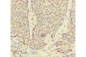 Immunohistochemistry of paraffin-embedded human ovarian cancer using ABIN7175186 at dilution of 1:100 (UACA 抗体  (AA 1-90))