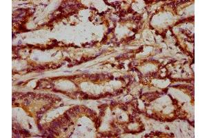 IHC image of ABIN7152685 diluted at 1:293 and staining in paraffin-embedded human colon cancer performed on a Leica BondTM system. (FRMD6 抗体  (AA 413-622))