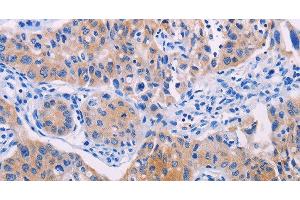 Immunohistochemistry of paraffin-embedded Human lung cancer using AGT Polyclonal Antibody at dilution of 1:30 (AGT 抗体)