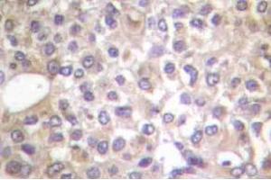 Immunohistochemistry (IHC) analyzes of p-PI3K p85 (pTyr458)/p55 (pTyr199) antibody in paraffin-embedded human breast carcinoma tissue. (PIK3R1 抗体  (pTyr199, pTyr458))