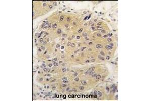 Formalin-fixed and paraffin-embedded human lung carcinoma tissue reacted with EIF4A1 antibody (N-term) (ABIN391393 and ABIN2841397) , which was peroxidase-conjugated to the secondary antibody, followed by DAB staining. (EIF4A1 抗体  (N-Term))