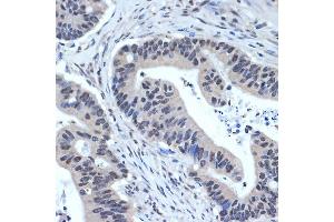Immunohistochemistry of paraffin-embedded human colon carcinoma using XPD/ERCC2 Rabbit mAb (ABIN7267057) at dilution of 1:100 (40x lens). (ERCC2 抗体)