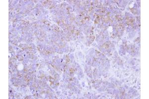 IHC-P Image Immunohistochemical analysis of paraffin-embedded SW480 xenograft, using ST3GAL2, antibody at 1:100 dilution. (ST3GAL2 抗体)
