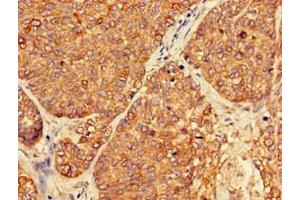 Immunohistochemistry of paraffin-embedded human ovarian cancer using ABIN7162911 at dilution of 1:100 (PER3 抗体  (AA 1-131))