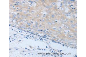 Immunohistochemistry of Human cervical cancer using CHRFAM7A Polyclonal Antibody at dilution of 1:40 (CHRNA7 抗体)