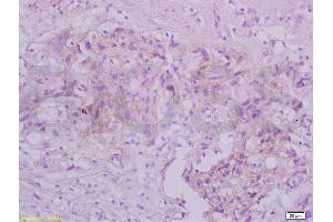 Formalin-fixed and paraffin embedded human gastric carcinoma tissue labeled with Anti-TRAF3/CD40bp Polyclonal Antibody, Unconjugated (ABIN738921) at 1:200 followed by conjugation to the secondary antibody and DAB staining (TRAF3 抗体  (AA 101-200))
