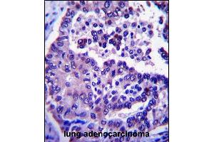 ARL8A Antibody (Center) (ABIN657381 and ABIN2846426) immunohistochemistry analysis in formalin fixed and paraffin embedded human lung adenocarcinoma followed by peroxidase conjugation of the secondary antibody and DAB staining. (ARL8A 抗体  (AA 82-110))