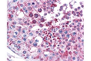 MAGEA3 antibody was used for immunohistochemistry at a concentration of 4-8 ug/ml. (MAGEA3 抗体  (Middle Region))