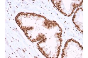 Formalin-fixed, paraffin-embedded human Prostate Carcinoma stained with APEX Nuclease I Mouse Monoclonal Antibody (CPTC-APEX1-2).
