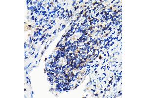 Immunohistochemistry of paraffin-embedded human lung cancer using GRB2 Rabbit mAb (ABIN7267518) at dilution of 1:100 (40x lens). (GRB2 抗体)