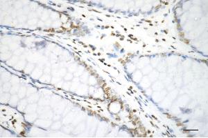 Immunohistochemistry was performed on paraffin-embedded human sigmoid colon carcinoma using histone H3 (di methyl K9) antibody (ABIN7798957), 1:200). (Recombinant Histone 3 抗体  (H3K9me2))