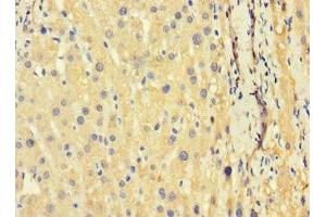 Immunohistochemistry of paraffin-embedded human liver cancer using ABIN7173626 at dilution of 1:100 (TSC22D3 抗体  (AA 58-134))