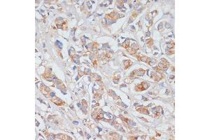 Immunohistochemistry of paraffin-embedded human breast cancer using DLL1 antibody (ABIN7266726) at dilution of 1:100 (40x lens). (DLL1 抗体  (AA 573-723))