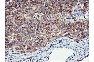 Immunohistochemical staining of paraffin-embedded Adenocarcinoma of Human ovary tissue using anti-AGPAT5 mouse monoclonal antibody. (AGPAT5 抗体)