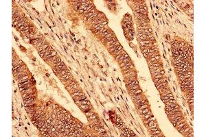 Immunohistochemistry analysis of human colon cancer using ABIN7163605 at dilution of 1:100