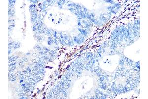 Immunohistochemistry of paraffin-embedded human colon carcinoma using Galectin 1/LG Rabbit mAb (ABIN7268197) at dilution of 1:100 (40x lens). (LGALS1/Galectin 1 抗体)