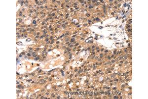 Immunohistochemistry of Human breast cancer using TLN1 Polyclonal Antibody at dilution of 1:35 (TLN1 抗体)