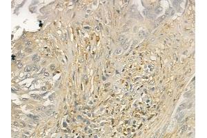ABIN6260596 and ABIN6277004 at 1/100 staining human lung squamous cell carcinoma by IHC-P. (2B4 抗体  (N-Term))