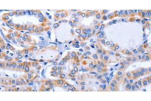 Immunohistochemistry of paraffin-embedded Human thyroid cancer using GFER Polyclonal Antibody at dilution of 1:50 (GFER 抗体)