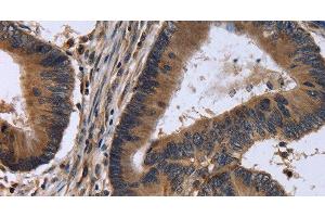 Immunohistochemistry of paraffin-embedded Human colon cancer tissue using FSTL1 Polyclonal Antibody at dilution 1:30 (FSTL1 抗体)