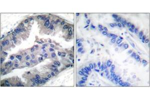 Immunohistochemical staining of paraffin-embedded human lung carcinoma tissue reacted with BIK (phospho T33) polyclonal antibody  at 1:50-1:100 dilution. (BIK 抗体  (pThr33))