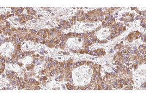 ABIN6273974 at 1/100 staining Human liver cancer tissue by IHC-P. (OR1L4/1L6 抗体)