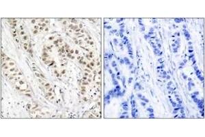 Immunohistochemistry analysis of paraffin-embedded human breast carcinoma, using BRCA1 (Phospho-Ser1524) Antibody. (BRCA1 抗体  (pSer1524))