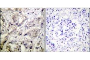 Immunohistochemistry analysis of paraffin-embedded human breast carcinoma tissue, using CaMK1-alpha (Ab-177) Antibody. (CAMK1 抗体  (AA 143-192))