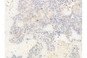 ABIN7095862 and ABIN7099924 at 1/100 staining human breast carcinoma by IHC-P. (RBM7 抗体)
