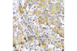Immunohistochemistry of paraffin-embedded human lung cancer using ZDHHC18 antibody (ABIN7271549) at dilution of 1:100 (40x lens). (ZDHHC18 抗体  (AA 301-388))