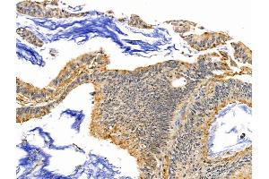 SLFN11 Antibody at 1/100 staining Human colorectal cancer by IHC-P. (SLFN11 抗体  (N-Term))