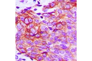 Immunohistochemical analysis of Claudin 1 staining in human breast cancer formalin fixed paraffin embedded tissue section. (Claudin 1 抗体  (C-Term))