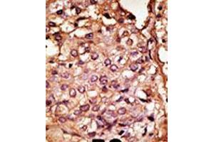 Formalin-fixed and paraffin-embedded human cancer tissue reacted with the primary antibody, which was peroxidase-conjugated to the secondary antibody, followed by AEC staining. (CCBP2 抗体  (N-Term))